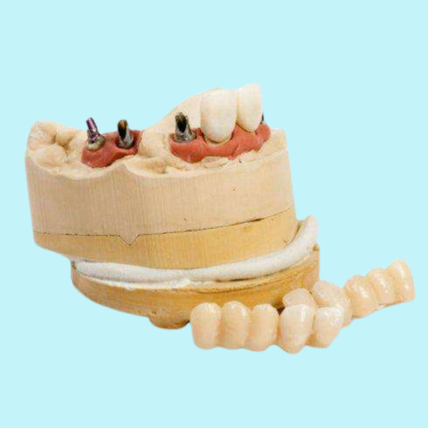 Customized Dental Implant Replacement Durable Titanium Dental Implant