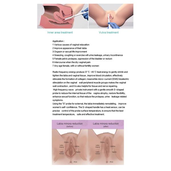 Safety RF female intimate areal tightening /female intimate areal rejuvenation labia tighten beauty machine