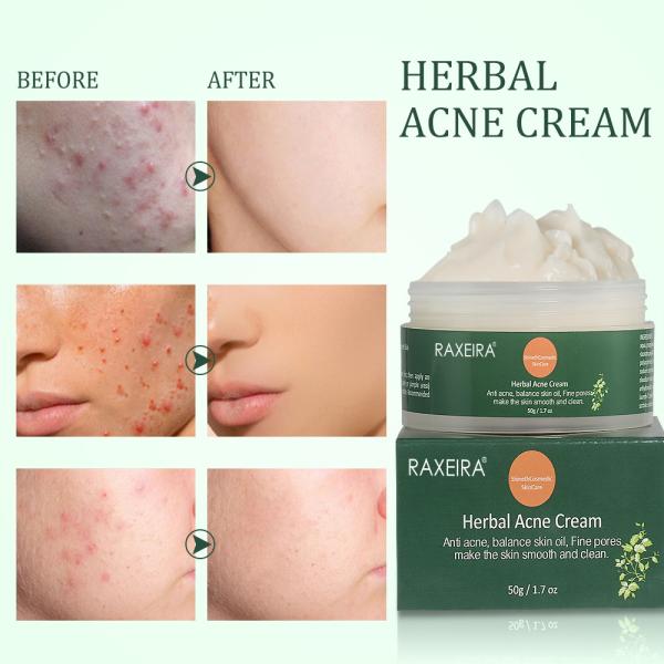 Natural Organic Herbal Cleansing Face Cream Skin Care Acne Scar Remove Treatment