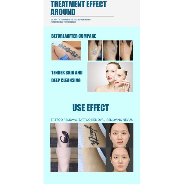 1320w Q Switch Nd Yag Laser Machine Commercial Tattoo Removal Beauty Machine Painless