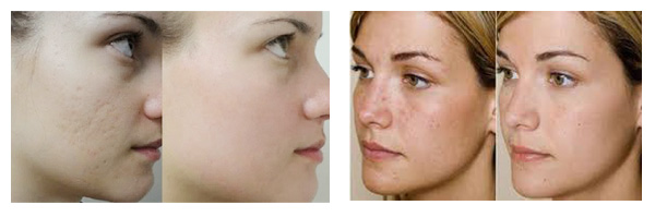 Electric Home Use Beauty Machine 0.25mm - 3.0mm Adjustable Lengths Included