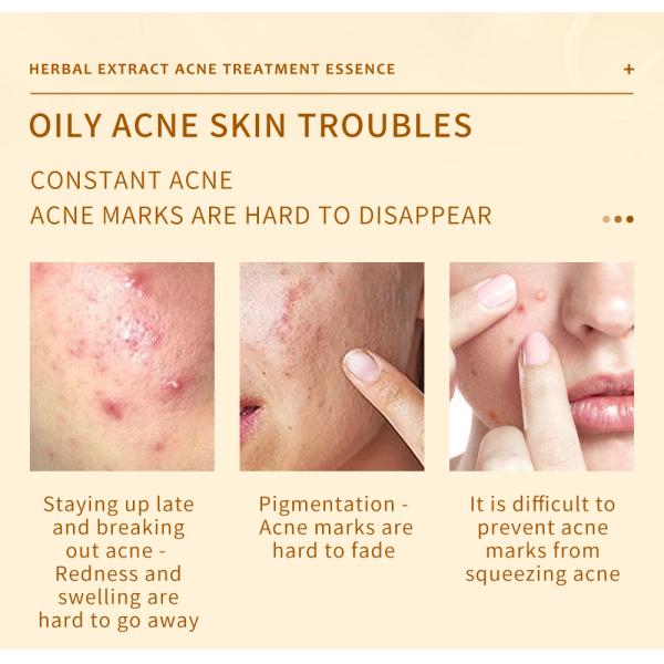 Skincare Essence Face Serum Moisturizer Cream For Anti Acne Facial Whitening 50g