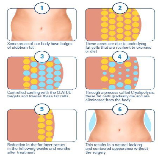 Fat Freezing 6Hz Vela Slimming Machine