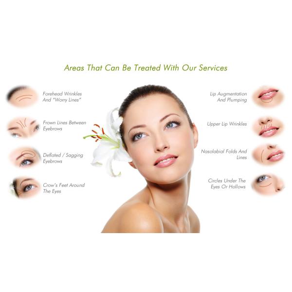 Customization PLLA Dermal Filler 150mg 360mg 350mg Injectable