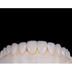 Ultra-simulated dental zirconia aesthetic veneers