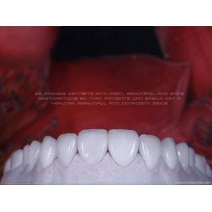Zirconia Ceramic Veneer Natural White