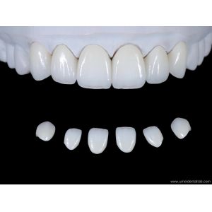 Ultra-simulated dental zirconia aesthetic veneers