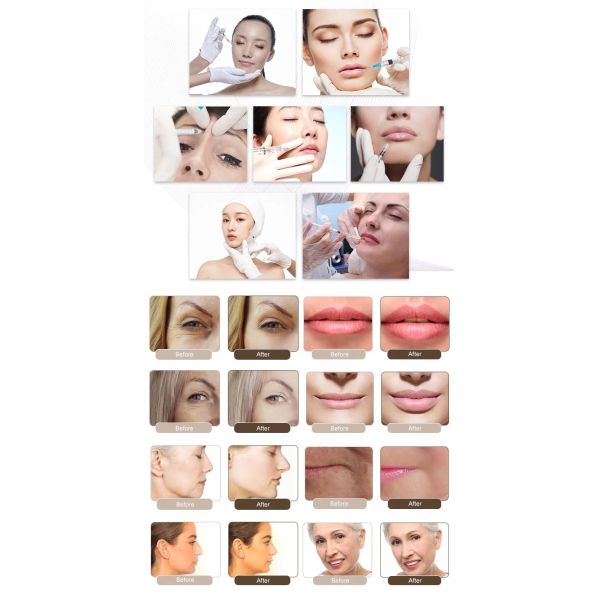 Revolax Hyaluronic Acid Lip Injections 1.1ml