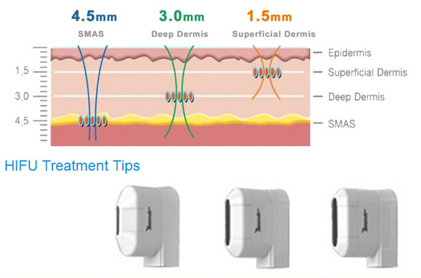 2016 most popular slimming machine HIFU-1 ultrasound face lifting